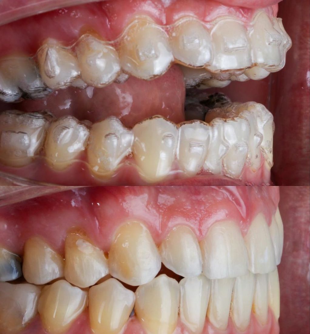 Ortodoncia Invisible